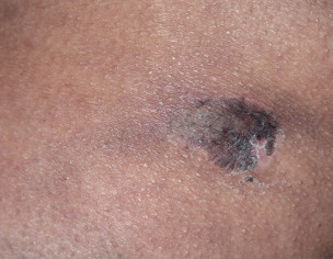 Misplaced Injection