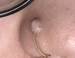 Bump Around Nose