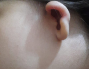 Ear Deformity / Possible Microtia Concern