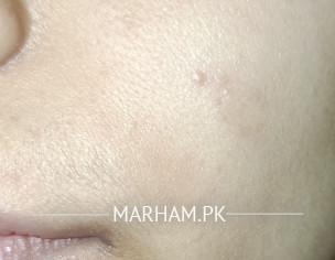 Dry Patch Face