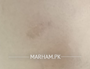 Dry Patch Face