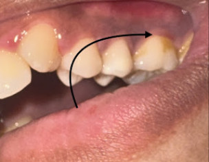 Toothache