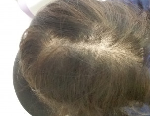 Hair Baldness