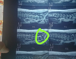 Disc Issue