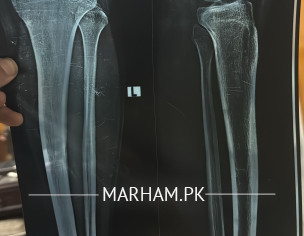 Leg Pain Problem