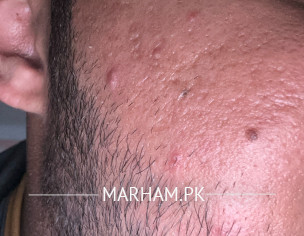 Acne Scar Probleem