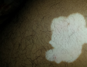 Vitiligo White Patches