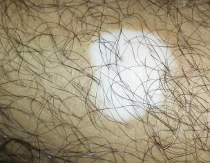 Vitiligo White Patches