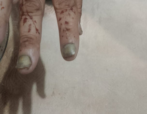 Nails Bad Condition