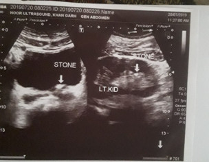 Ureter Stone