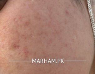 Face Spots