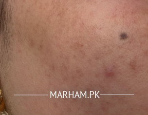 Face Spots