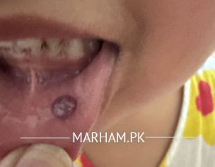 Blister Inside Lower Lip