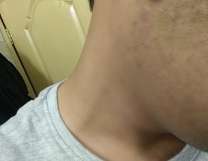 Warts Problem 