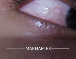 Eye Problem