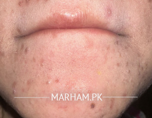 Comedonal Acne 