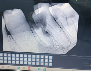 Damaged Molar