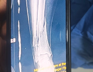 Bone Damaged