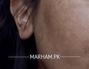 Mesotherapy 