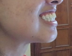 Overbite Issue , Smile Isnt Balanced