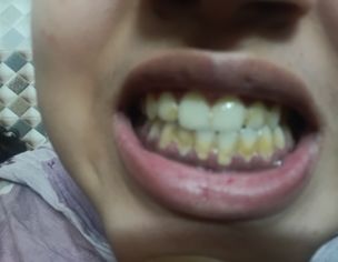 Teeth Problem