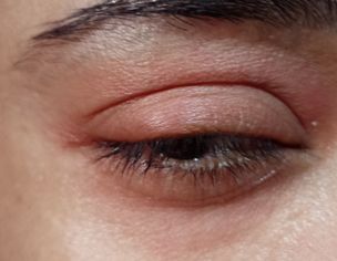 Eyes Swiling