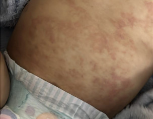 Eczema Problem