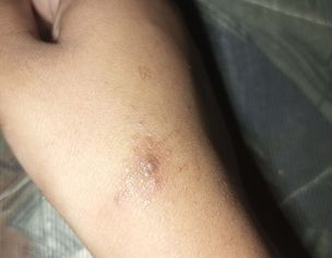 Skin Issue