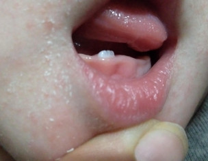Baby First Tooth
