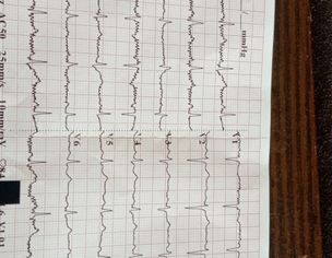 Left Side Pain In Hand And Chest