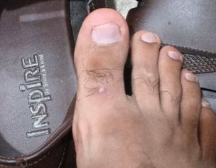 Pimple On Foot