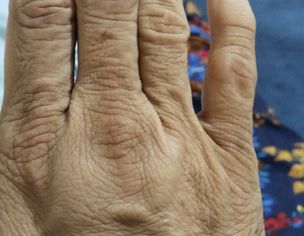 My Middle Finger Bottom Joint Swelling And Pain Out Side Palm