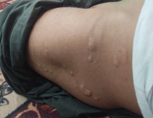 Skin Allergy