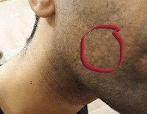 Psoriasis, Baalchar, Facial Hair Loss/hard Bumps Under Cheeks(plain On Surface)