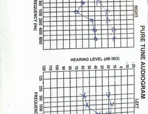 Ent (hearing)