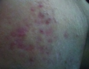 Acne Problem