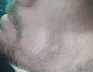 Skin Issues