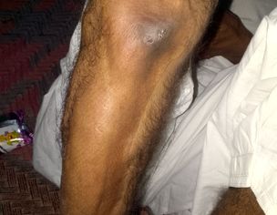 Severe Knee, Hand, And Finger Pain