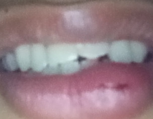 Dental Problem