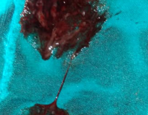 Clots In Bleeding