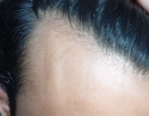 Male Pattern Baldness