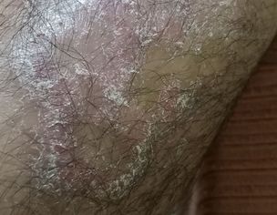 Psoriasis Skin Issue