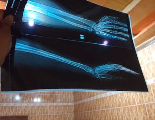 Severe Wrist Pain And Suspected Bone Dislocation