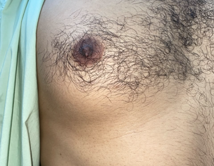 Irritation On Nipple