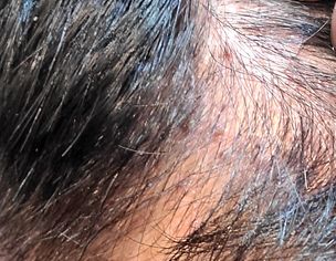 Hair Acne