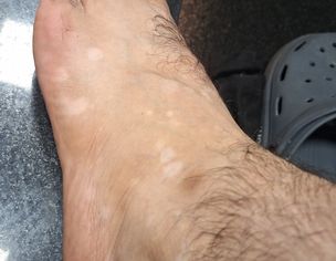 Vitiligo