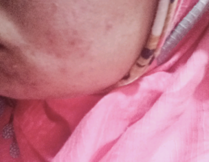 Acne /pimples