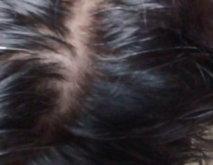 Hair Problem