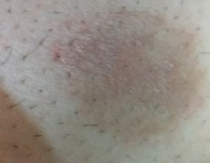Itchy Rashes