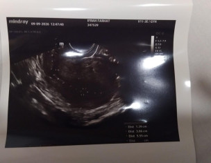 Endometriosis